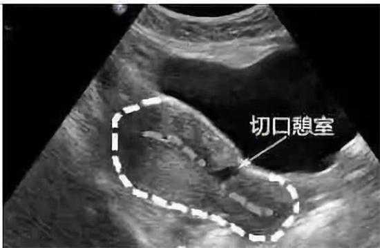 北京供卵不排队的医院_北京三甲医院供卵试管_最长20天！年轻女子月经紊乱苦